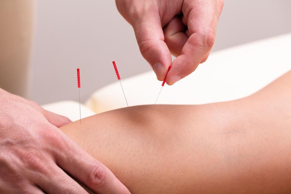 6 benefits of dry needling, dry needling, dry needling for injury prevention